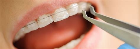 problems with ceramic braces